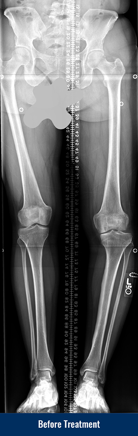 X-ray showing bowed leg before treatment