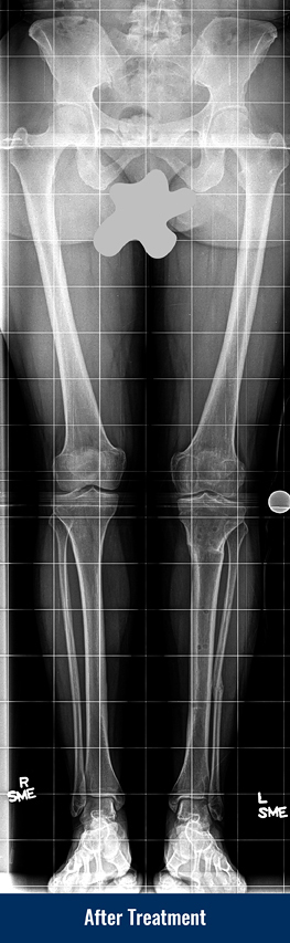 X-ray showing straightened leg after treatment