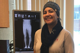 Damaris with straight legs after treatment by X-ray of bowed leg before treatment