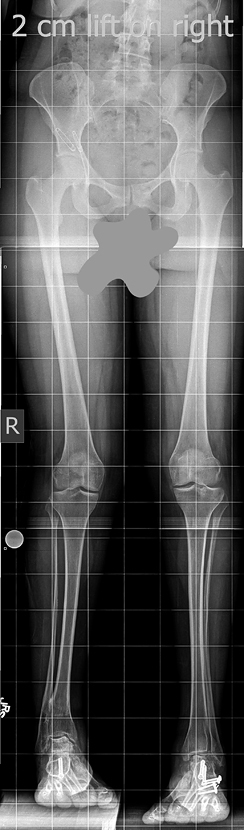 X-ray of Lisa's legs before treatment showing a 2 cm difference in leg length