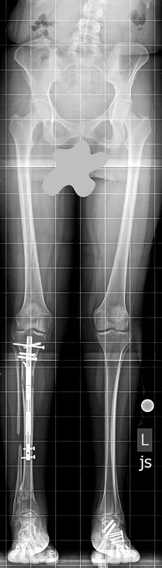 X-ray of Lisa's legs after Precice lengthening treatment showing legs of equal length