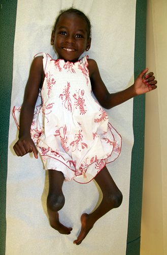 Melissa as a young child laying on an exam table with severe club feet and arthrgryposis