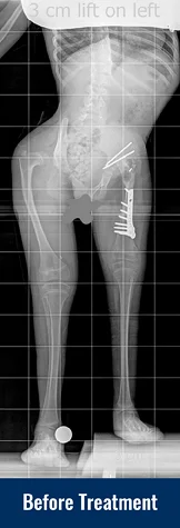 Alena's X-ray before her most recent treatment