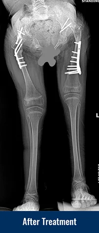 Alena's X-ray after her most recent treament showing much improved bone alignment