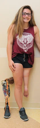 Brooklynn as a teenager standing showing her leg after rotationplasty next to her prosthetic