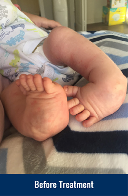 Cannon's feet before clubfoot treatment