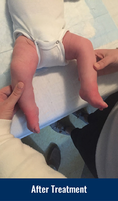 Cannon's feet after clubfoot treatment
