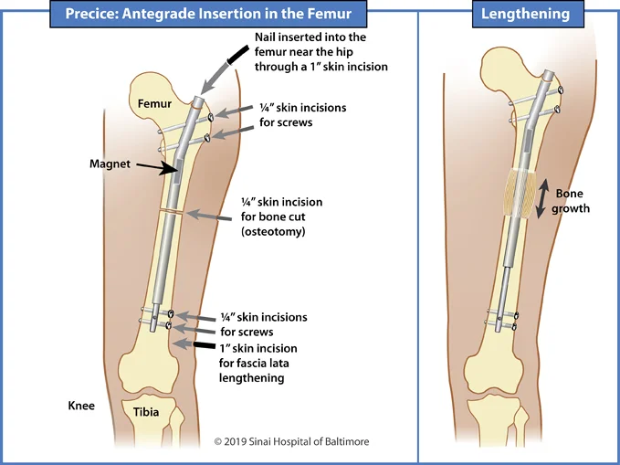 Illustrations showing antegrade insertion of a Precice nail into the femur for limb lengthening and deformity correction