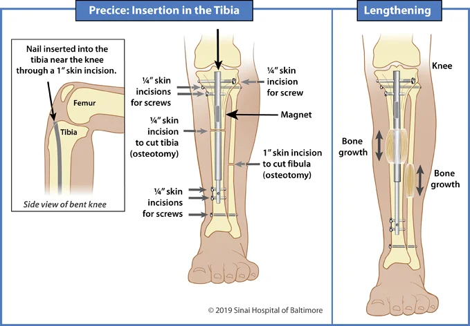 Illustrations showing insertion of a Precice nail into the tibia for limb lengthening and deformity correction
