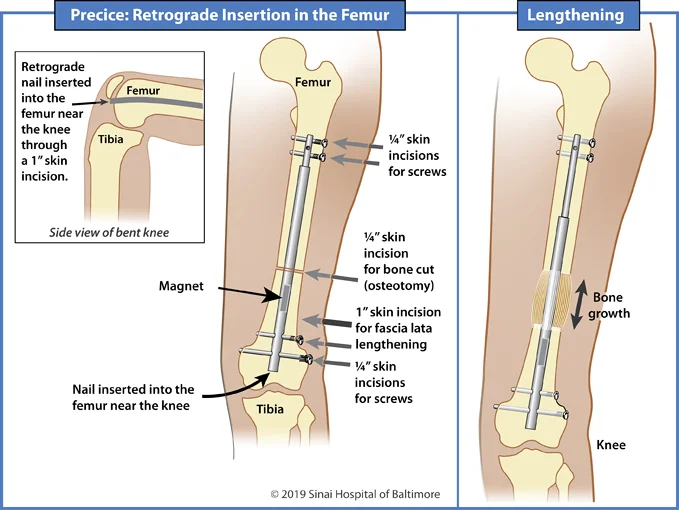 Illustrations showing retrograde insertion of a Precice nail into the femur for limb lengthening and deformity correction