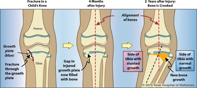 Illustrations of the immature bones around the knee, showing a medial proximal tibial growth plate fracture, and a malaligned knee after two years if left untreated.