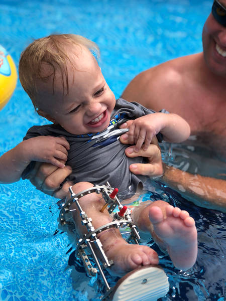 A baby with an external fixator on his leg swimming in a pool