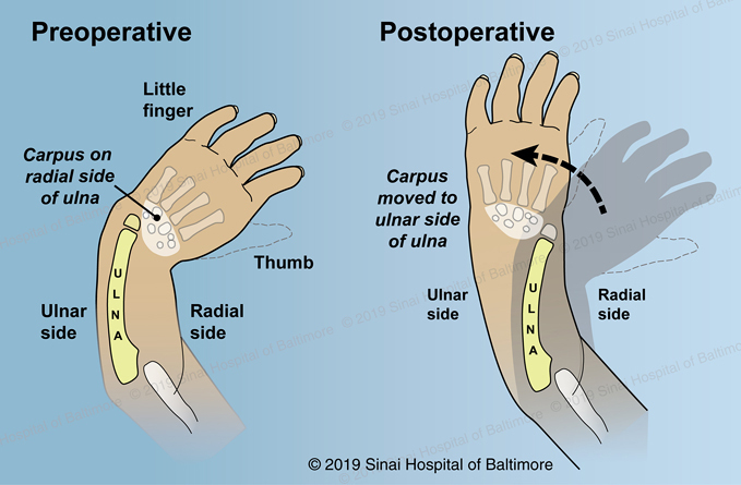 An illustration showing the hand and forearm before and after ulnarization
