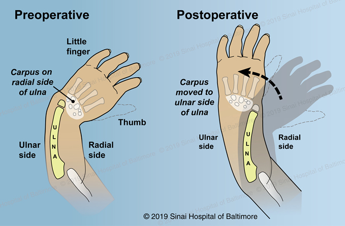 Ulnarization | International Center for Limb Lengthening