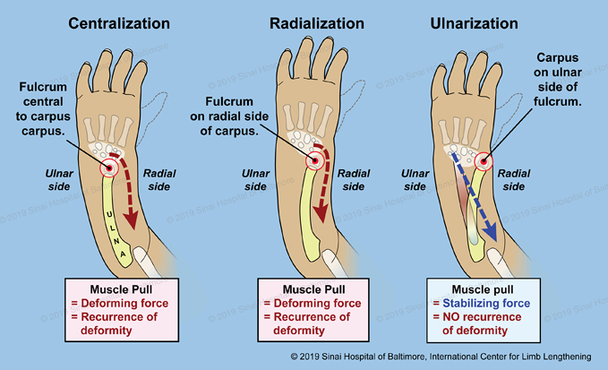 Radial Longitudinal Deficiency (Radial Club Hand)