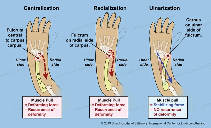 An illustration with three figures showing the differences between the centralization, radialization, and ulnarization techniques as explained below