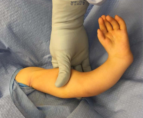 A photo of a surgeon showing the draped arm of a child before ulnarization surgery