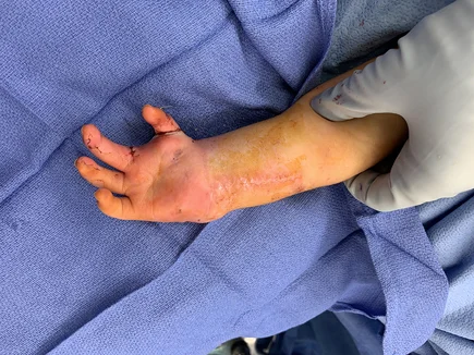 A surgeon’s gloved hand showing the child’s hand and arm after a pollicization