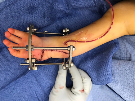 A surgeon’s gloved hand showing the child’s hand and arm after ulnarization with an external fixator applied