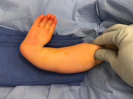 A surgeon’s gloved hand showing a child’s draped club hand and arm prior to surgery