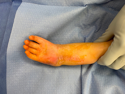 A surgeon’s gloved hand showing the child’s hand and arm after the external fixator was removed 3 months after ulnarization surgery