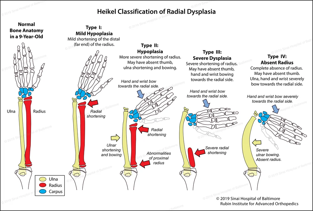 An illustration showing normal bone anatomy in a 9-year-old’s hand and arm compared to 4 different types of radial club hand ranging from Type 1: mild hypoplasia to Type 4: a completely absent radius.
