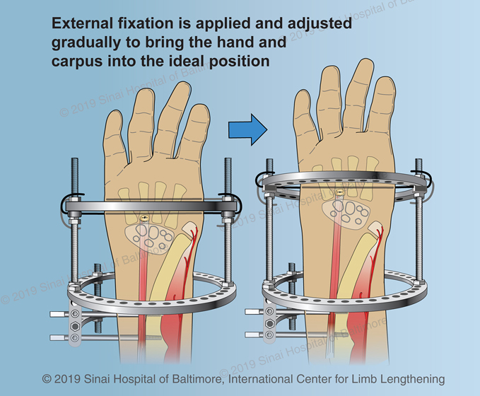 Ulnarization | International Center for Limb Lengthening