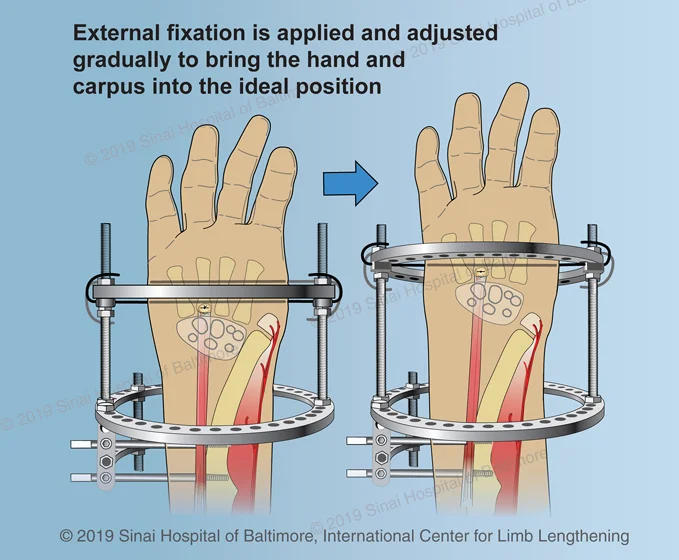 An illustration showing how the external fixator is applied and how it is adjusted gradually to bring the hand and carpus into the ideal position as described in step 8 of the ulnarization procedure described above.