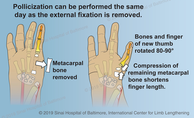 Club Hand  International Center for Limb Lengthening