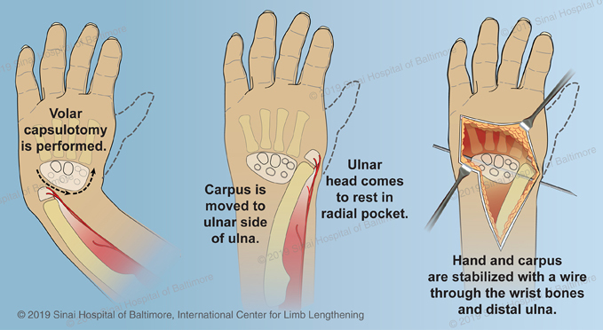 Ulnarization | International Center for Limb Lengthening