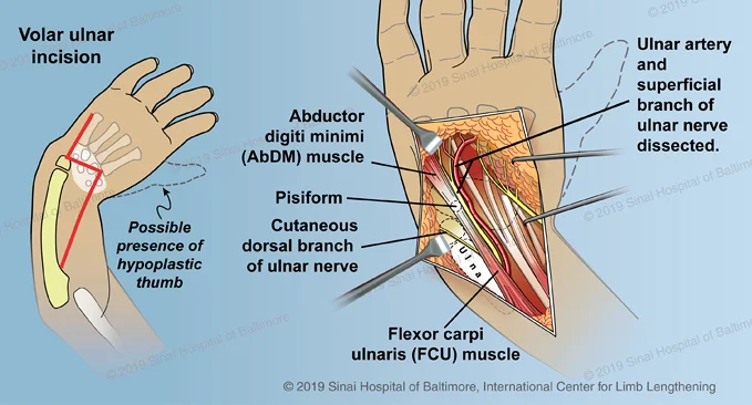 An illustration showing steps one and two of the ulnarization procedure described above