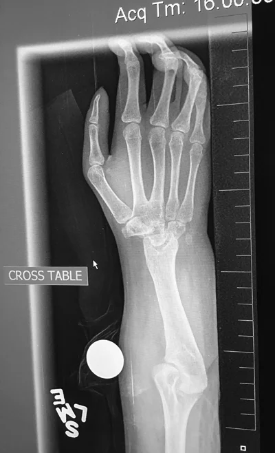 X-ray showing a 19-year-old female who had a centralization procedure at the age of 18 months. The wrist is fused and the ulna is only 8.5 cm (3 1/2 in) in length.