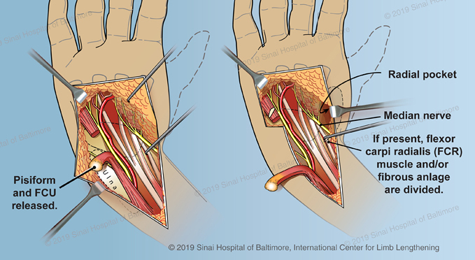 Club Hand  International Center for Limb Lengthening