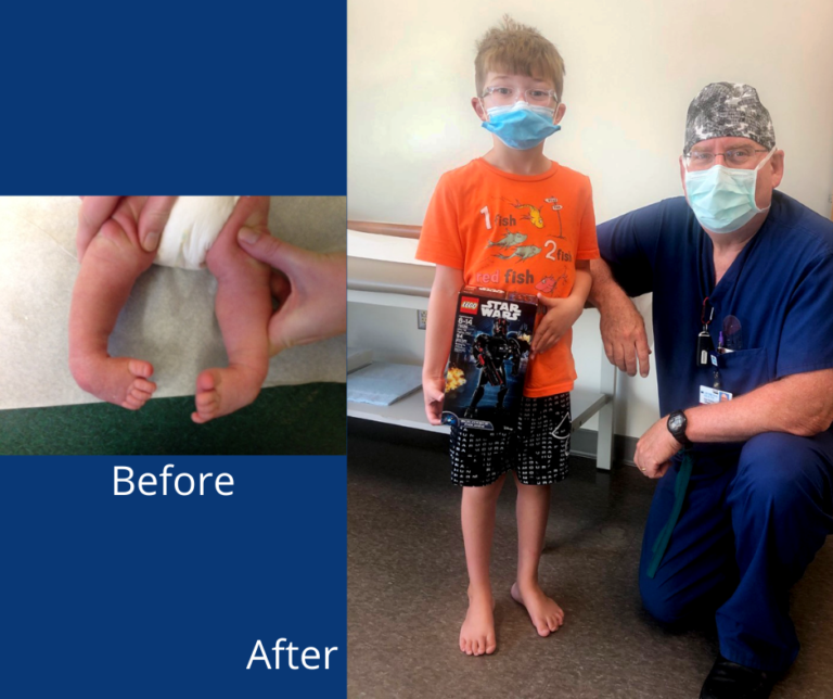 Before photo of Thomas’ legs as a baby with clubfoot, and after photo of Thomas with Dr. Herzenberg after graduating from his boots and bar