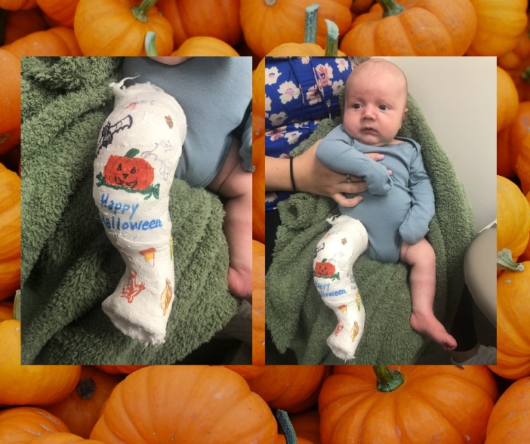 A baby with clubfoot with a cast on his leg that is decorated with a pumpkin for Halloween