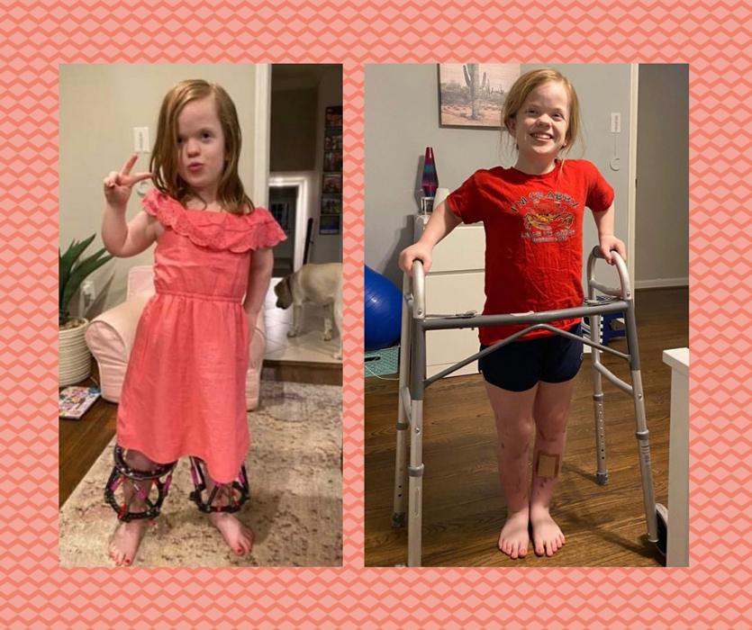 A before and after of Anaïs showing her with external fixators on her legs, and standing with a walker after her external fixators were removed.