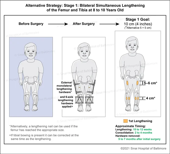 Achondroplasia: Alternative Strategy 1: 1st Stage: Bilateral simultaneous lengthening of the femur and tibia at around 8 to 10 years old to include femoral external monolateral lengthening hardware and tibial six-axis external lengthening hardware
