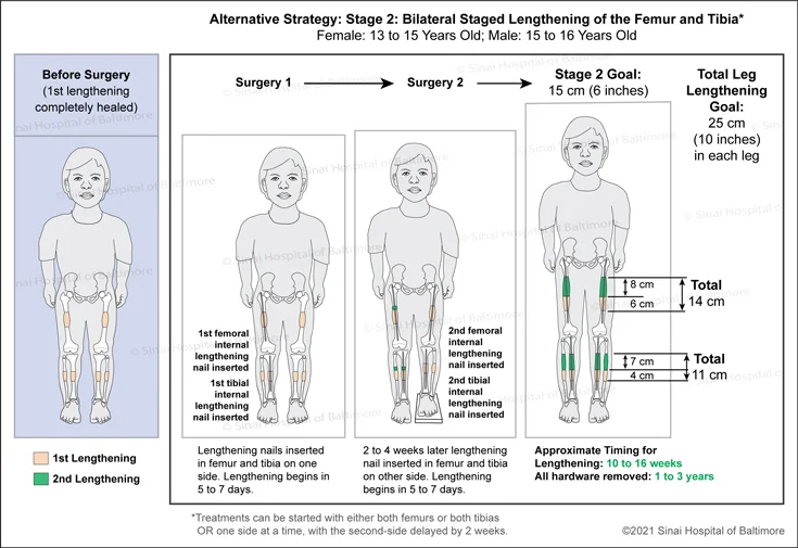 Achondroplasia: Surgical Treatment Plan for Lengthening, Alternative Strategy 1, 2nd Stage: Bilateral staged lengthening of the femur and tibia at around 13 to 15 years old for females and 15 to 16 years old for males to include femur and tibia lengthening nails in one side of the lower limb. Nails are inserted in the other side 2 to 4 weeks later.