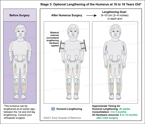 Achondroplasia: Surgical Treatment Plan for Optional Lengthening of the Humerus to include bilateral external monolateral lengthening hardware applied.