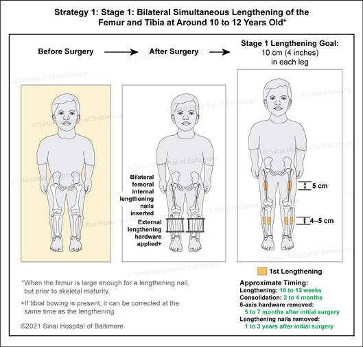 Achondroplasia: Strategy 1: 1st Stage: Bilateral simultaneous lengthening of the femur and tibia at around 10 to 12 years old to include femoral lengthening nails, six-axis external lengthening hardware