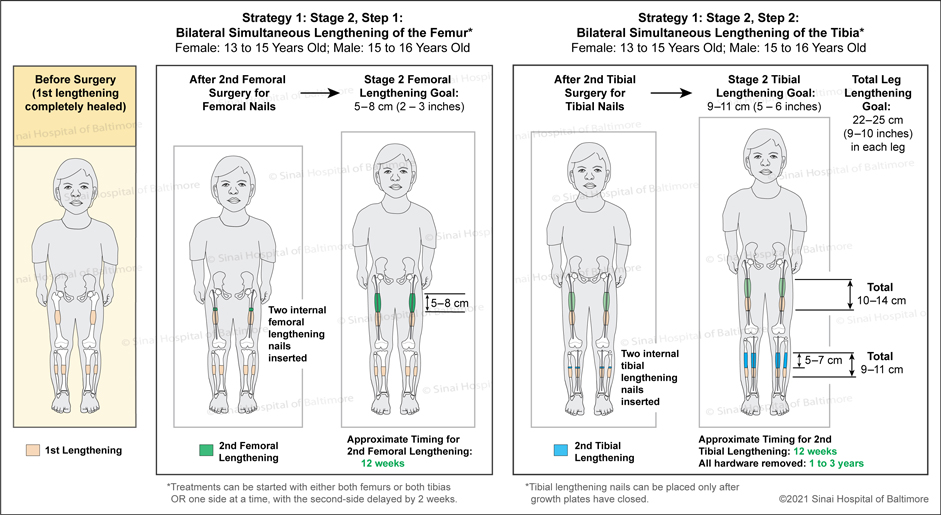 Achondroplasia: Strategy 1: Stage 2, Bilateral Simultaneous Lengthening of the Femur, Female: 13 to 15 Years Old; Male: 15 to 16 Years Old, Step 1 to include internal femoral lengthening nail; Step 2 to include two internal tibial lengthening nails