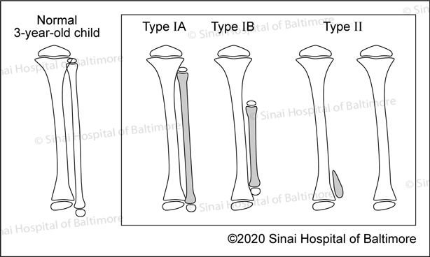 Achterman and Kalamchi Classification of Fibular Hemimelia: Type IA, Type IB, and Type II