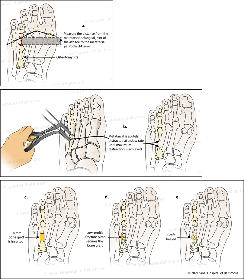 Illustration of acute lengthening for brachymetatarsia of the fourth toe. On the patient’s pre-operative X-ray the surgeon uses established angles of the foot to analyze the length required to normalize the short toe. The bone cut (osteotomy) is planned in the fourth metatarsal bone. Surgical instruments are used at the osteotomy site to slowly separate the fourth metatarsal bone until the planned lengthening (distraction) is achieved. Bone from the patient’s hip is placed into the new metatarsal bone gap. A wire is inserted through the bones of the fourth toe to hold the bone graft in place. Alternatively, in the single-staged procedure, a plate can be utilized instead of a wire to secure the graft during healing.