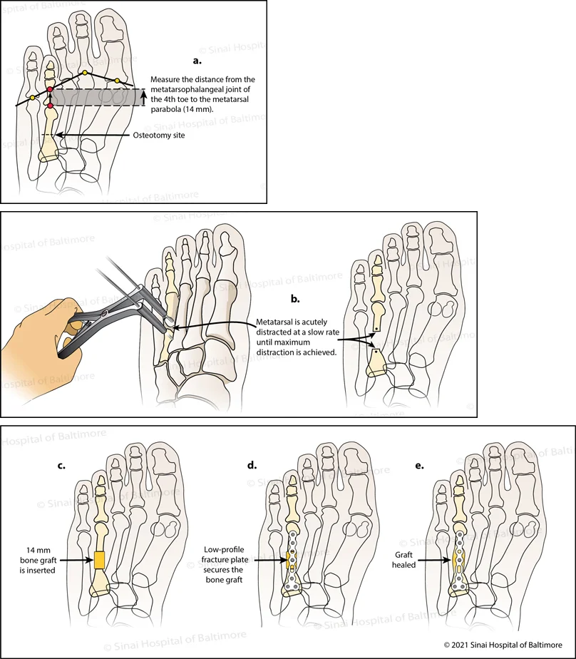 Illustration of acute lengthening for brachymetatarsia of the fourth toe. On the patient’s pre-operative X-ray the surgeon uses established angles of the foot to analyze the length required to normalize the short toe. The bone cut (osteotomy) is planned in the fourth metatarsal bone. Surgical instruments are used at the osteotomy site to slowly separate the fourth metatarsal bone until the planned lengthening (distraction) is achieved. Bone from the patient’s hip is placed into the new metatarsal bone gap. A wire is inserted through the bones of the fourth toe to hold the bone graft in place. Alternatively, in the single-staged procedure, a plate can be utilized instead of a wire to secure the graft during healing.