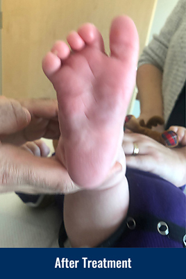The bottom of a child's foot after being treated for metatarsus adductus