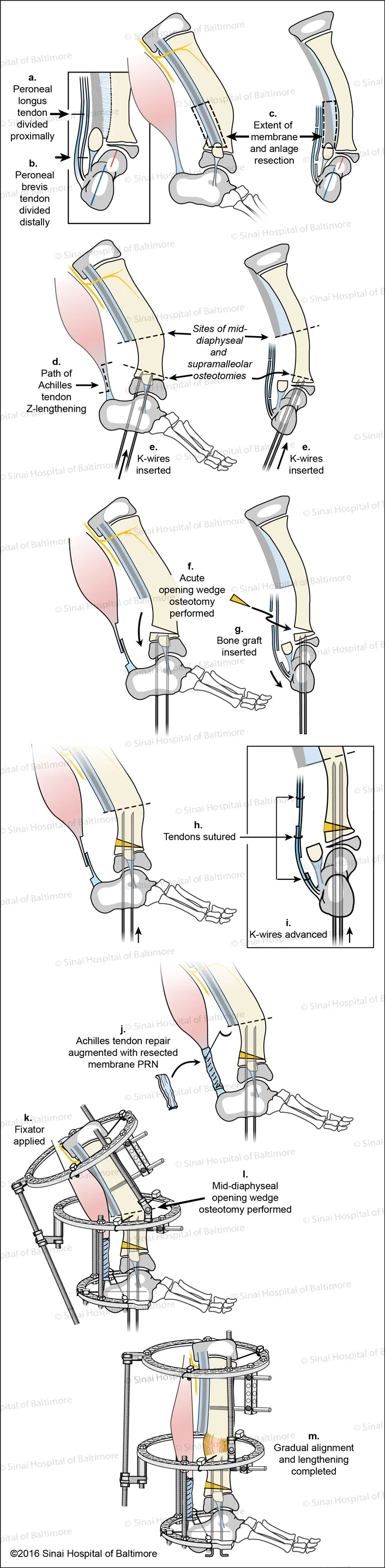 SUPERankle Surgical Technique for Supramalleolar Type Fibular Hemimelia (Paley Type 3A - ankle type ) Fig. A, AP View, Peroneal longus tendon is divided proximally. B, AP View, Peroneal brevis tendon is divided distally. C, Lateral and AP views, The extent of the membrane and anlage resection is identified; D, E, AP and Lateral views, Path of Achilles tendon Z-lengthening, sites of mid-diaphyseal and supramalleolar osteotomies are identified, k-wires are inserted; F, Acute opening wedge osteotomy performed; G, Bone graft is inserted; H, Tendons are sutured; I, K-wires are advanced; J, Achilles tendon repair is augmented with resected membrane as needed; K, Fixator is applied; L, Mid-diaphyseal opening wedge osteotomy is performed; M, Gradual alignment and lengthening is completed.