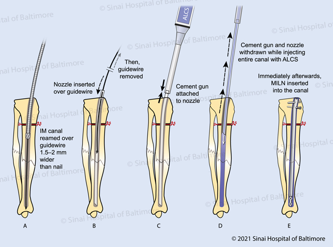 Color illustrations, figures A-E depicting injection of antibiotic-loaded cement spacer (ALCS) paste into tibial canal before placing an internal Precice magnetic internal lengthening nail (MILN). A. IM nail reamed over guidewire 1.5–2 mm wider than nail; B. Nozzle inserted over guidewire. Then guidewire removed.; C. Cement gun attached to nozzle; D. Cement gun and nozzle withdrawn while injecting entire canal with ALCS; E. Immediatley afterwards MLN inserted into canal.
