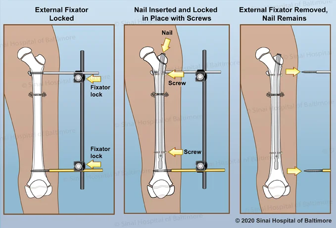 2-paneled color illustration depicting the process of correcting a rotational deformity near the knee of the femur. First external pins are placed to control the rotation of the bones; the femoral osetotomy is completed; detail shows the angle of the pins and bones from a 