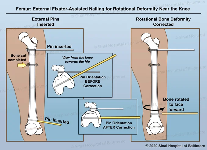 2-paneled color illustration depicting the process of correcting a rotational deformity near the knee of the femur. First external pins are placed to control the rotation of the bones; the femoral osetotomy is completed; detail shows the angle of the pins and bones from a 