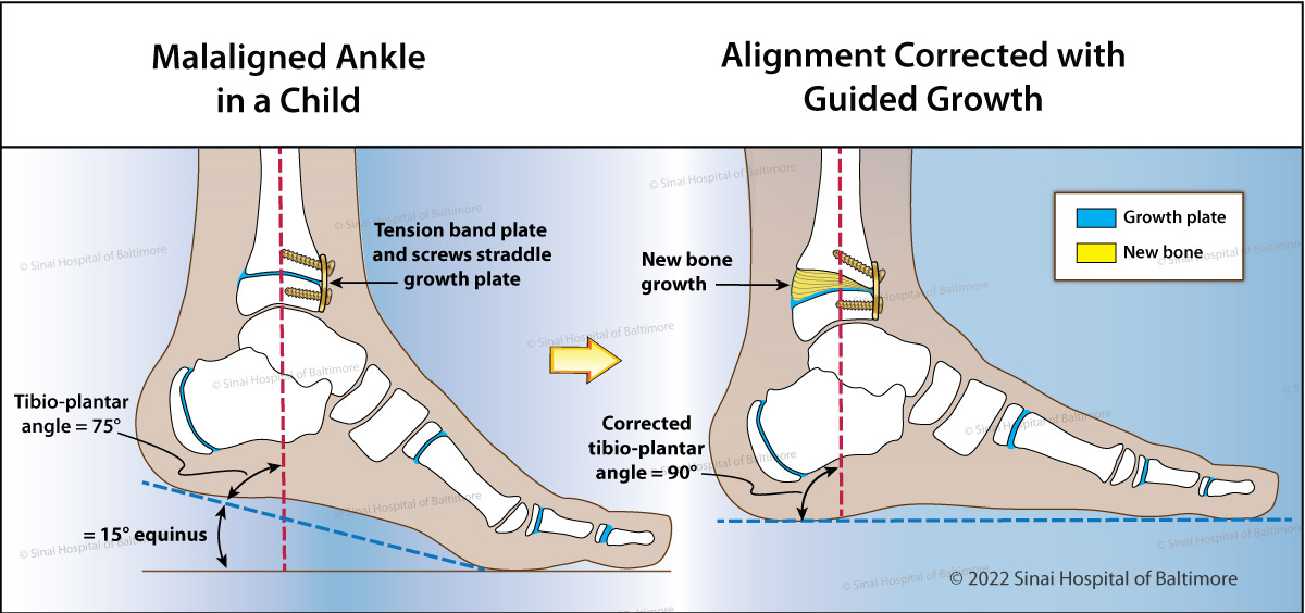 Medical illustration showing how guided growth is used to correct an ankle deformity